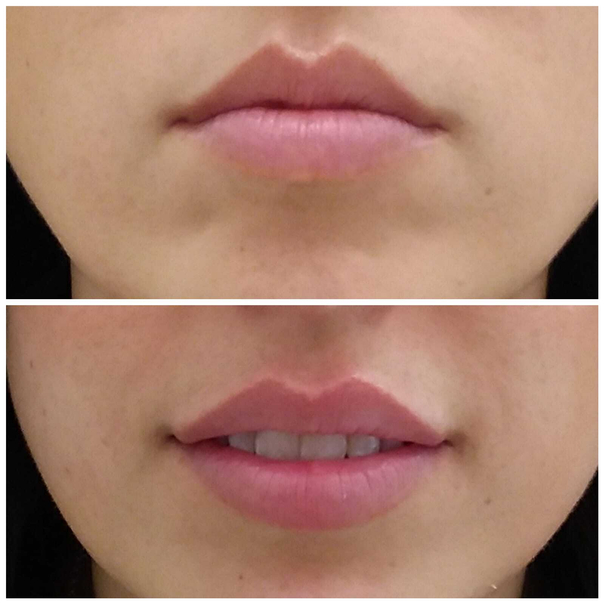 Prima e dopo filler labbra