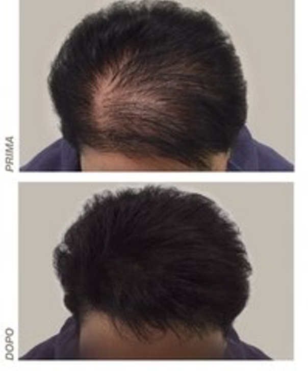 Prima e dopo trattamento alopecia