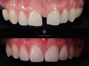 Miglioramento denti con faccette