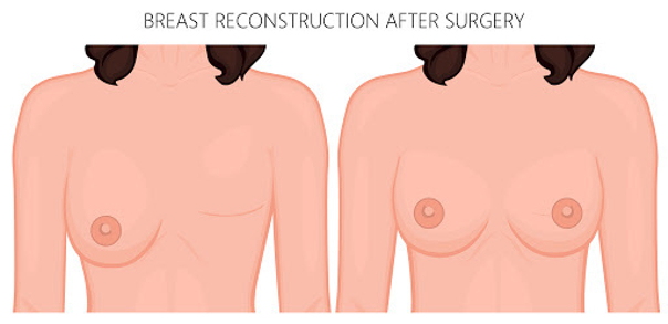 ricostruzione del seno