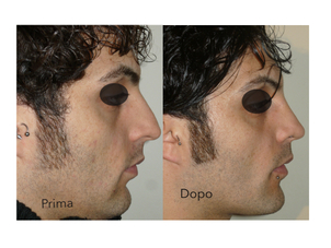 Risultati di genioplastica