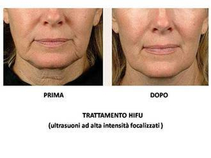 Trattamento hifu