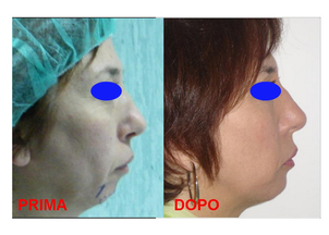 Mento di donna dopo intervento di mentoplastica