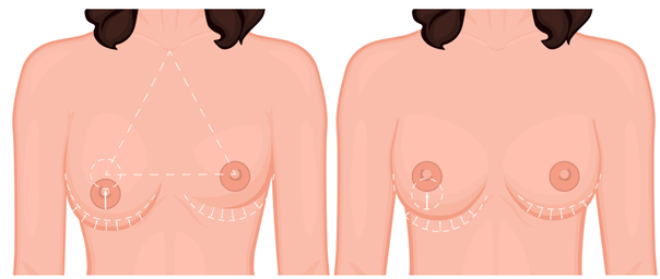 asimmetria mammaria