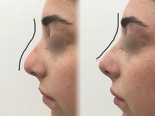 Prima e dopo risultati rinofiller