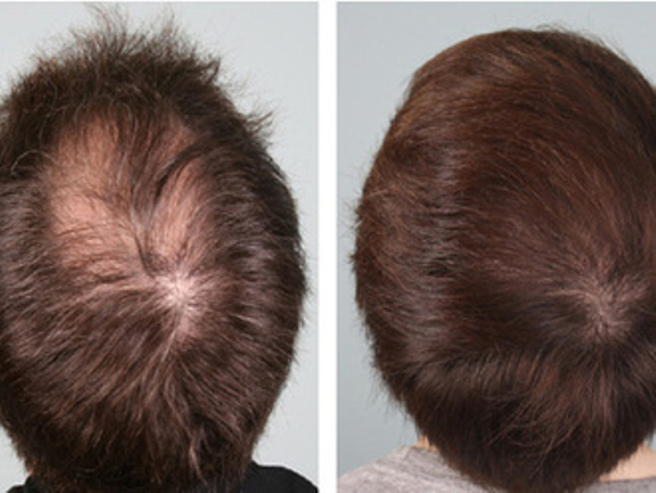 PRP per i capelli prima e dopo