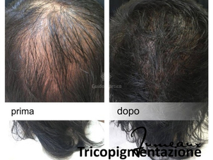 tricopigmentazione capelli lunghi