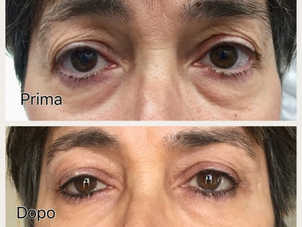 Immagine pre e post blefaroplastica senza chirurgia