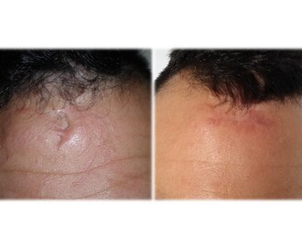 Modifica di un esito cicatriziale