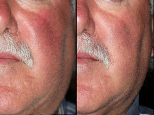 Paziente ideale per laser per couperose