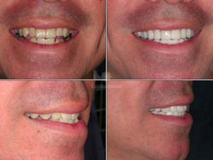 Apparecchio per i denti adulti