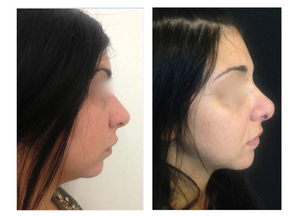 Profiloplastica in giovane donna