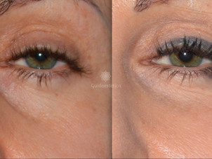 filler occhiaie prima e dopo