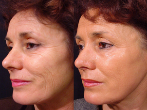 Prima e dopo iniezioni filler