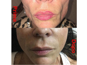 risultati filler viso