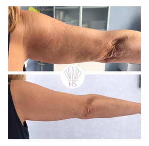 Trattamento braccia con laserterapia