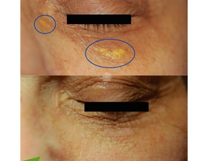 Xantelasmi cosa sono