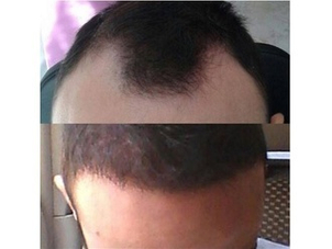 Risultati trattameno anticaduta capelli