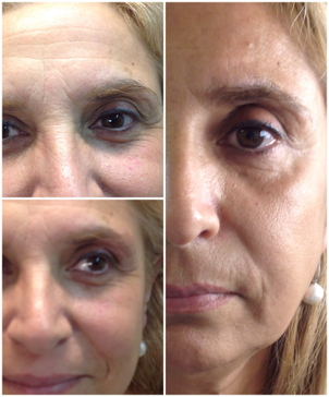 Qual è il risultato della blefaroplastica non chirurgica?