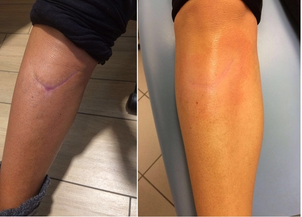 Eliminazione cicatrici con trattamento laser