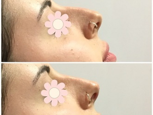 ^Prima e dopo iniezione di acido ialuronico naso