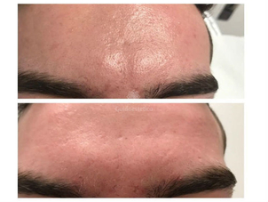 Peeling chimico per macchie viso