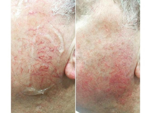 Trattamento capillari rischi