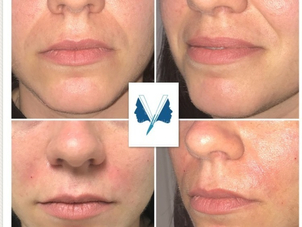 filler ringiovanimento viso