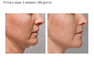 Radiofrequenza viso prima e dopo