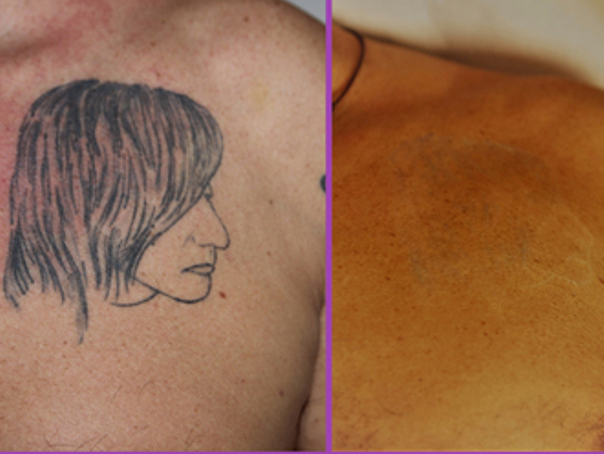Prima e dopo rimozione tatuaggio