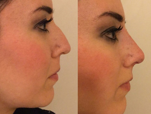 Risultati filler per il naso