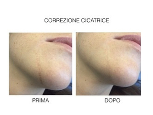 Livellamento cicatrice sul mento