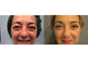 Risultati della blefaroplastica plexr