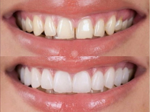 Installazione faccette dentali estetiche