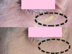 Come eliminare xantelasmi