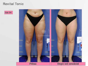 prima e dopo trattamento di velashape