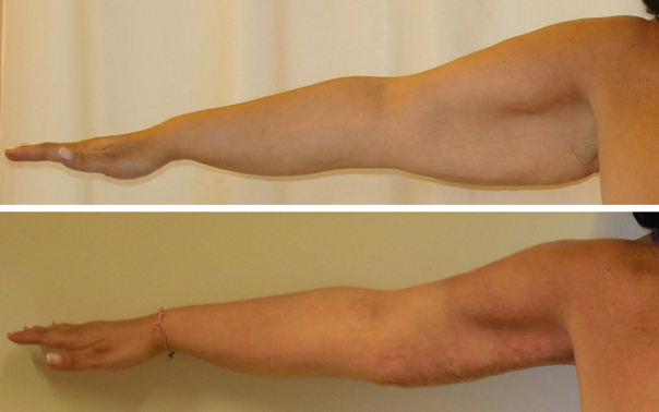 Liposuzione braccia: prima e dopo