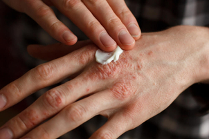 come curare psoriasi