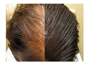 Trapianto dei capelli effetti