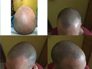 Tricopigmentazione risultati