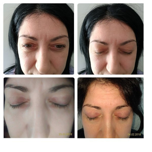 Blefaroplastica non ablativa prima e dopo