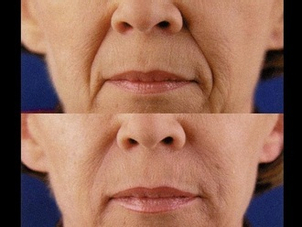 Lipofilling rughe della marionetta