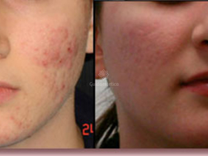 Peeling chimico acne