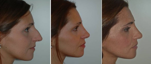 Rinoplastica prima e dopo