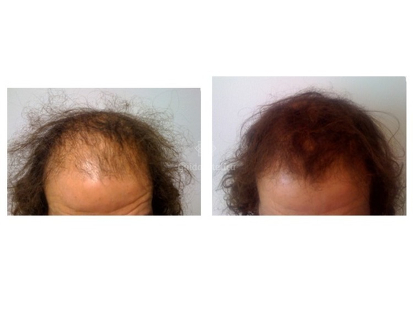 Alopecia prima e dopo