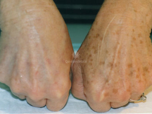 Eliminare macchie mani