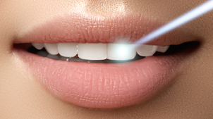 Laser Dentale principali utilizzi
