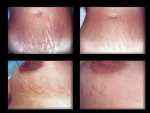 Prima e dopo cura Smagliature