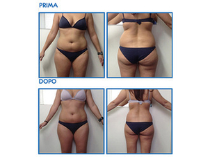 Prima e dopo ciclo di cavitazione