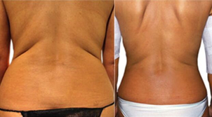 Prima e dopo ciclo di cavitazione